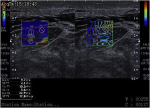 Elastografía: corte transversal del músculo recto femoral en paciente de 55años con fallo multiorgánico que muestra, en la parte inferior de la imagen, las cifras de kilopascales que traducen rigidez muscular en varias regiones de interés (ROI) (círculos rosas). Se visualiza líquido interfascial e intramuscular.