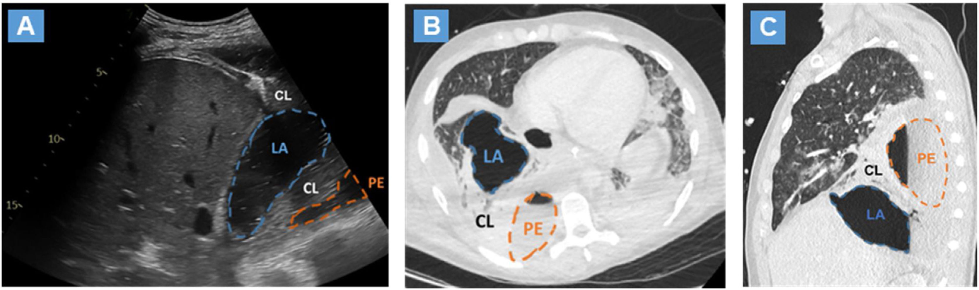 Point Of Care Lung Ultrasound Diagnosis Of Concomitant Lung Abscess And Pleural Empyema Due To A 8953