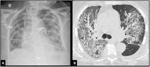 Imágenes de infiltrados bilaterales A) Rx torácica de frente. B) Tomografía axial computarizada corte transversal.