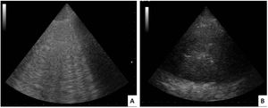Imágenes ecográficas pulmonares A) Patrón intersticial anormal de ecografía pulmonar: líneas B con tendencia a la coalescencia. B) Imagen de consolidación con broncograma aéreo (zona central hiperecogénica).