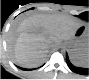 TC de abdomen sin CIV. Laceraciones hepáticas que afectan a todo el espesor del hígado hasta la vena cava inferior. Extenso hemoperitoneo derivado de lesión de vasos intrahepáticos.CIV: contraste intravenoso; TC: tomografía computarizada.