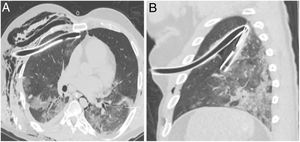 TC de tórax sin CIV con ventana de pulmón. A. Tubo de tórax derecho con trayecto intraparenquimatoso B. Tubo de tórax izquierdo acodado en cisura. CIV: contraste intravenoso; TC: tomografía computarizada.