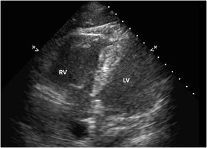 Apical 4-chamber view, dilated RV.