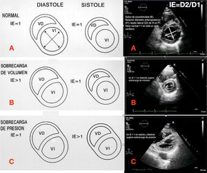 Interdependencia ventricular. VD: ventrículo derecho; VI ventrículo izquierdo; IE: índice de excentricidad; A. Patrón normal de excentricidad del VI; B. Sobrecarga de volumen, con aplanamiento del septo solo en diástole; C. Sobrecarga de presión, aplanamiento del septo en sístole y diástole; D2: diámetro anteroposterior del VI; D1: diámetro septo-lateral del VI.