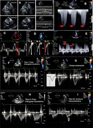 A. Variación de la vena cava inferior. Se muestra la imagen en 2D de inspiración y espiración y en modo M; B. Doppler continuo de la insuficiencia tricuspídea. La flecha roja señala la velocidad máxima de la insuficiencia tricuspídea; C. Tiempo de relajación isovolumétrica (TRIV); D. Tiempo de aceleración de la arteria pulmonar (Tac); E. Doppler pulsado de la insuficiencia pulmonar; las fechas señalan la velocidad máxima protodiastólica del flujo de la insuficiencia pulmonar (VIPpd) y la velocidad máxima del flujo de la insuficiencia pulmonar en telediástole (VIPtd); F. Flujo pulmonar tipo I normal con ascenso y descenso simétrico; G. Flujo de la arteria pulmonar tipo I, con flujo triangular simétrico, flujo normal; H. Flujo pulmonar tipo II con flujo triangular asimétrico, sugiere aumento de presión pulmonar; I. Flujo pulmonar tipo III, con la flecha que señala la incisura mesosistólica por cierre precoz de la válvula pulmonar.