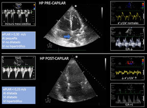 Signos sugestivos mediante ecocardiografía de hipertensión arterial pulmonar pre- y poscapilar. La flecha azul señala el septo interauricular abombado hacia la aurícula izquierda. AI: aurícula izquierda; ePLAR: ecocadiographic pulmonary to left atrial ratio=[VmaxIT/(E/e’) mitral]; HP: hipertensión pulmonar; TSVD: tracto de salida del ventrículo derecho; VI: ventrículo izquierdo.