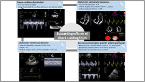 Utilidad de la ecocardiografía en el shock cardiogénico. Cálculo del gasto cardíaco mediante la fórmula volumen sistólico=área del tracto de salida del ventrículo izquierdo×integral velocidad tiempo del tracto de salida del ventrículo izquierdo. Evaluación de la función ventricular izquierda y derecha, así como análisis de las presiones de llenado y presión de arteria pulmonar mediante Doppler pulsado del flujo transmitral en relación al estudio mediante Doppler tisular del anillo mitral.
