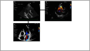 Complicaciones asociadas al síndrome coronario agudo que pueden conllevar un shock cardiogénico. A y B)Rotura septal con comunicación interventricular. C)Insuficiencia mitral isquémica.