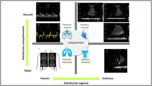 Estudio de la congestión en el shock cardiogénico. A)Estudio mediante Doppler pulsado del flujo transmitral. B)Estudio mediante Doppler tisular de la zona lateral del anillo mitral. C)Estudio mediante Doppler pulsado del flujo normal de la vena suprahepática; nótese que se compone de dos ondas anterógradas, una mayor sistólica (S) y otra menor diastólica (D), así como una onda retrógrada (sístole auricular). A medida que aumentan las presiones en la aurícula derecha, la onda S reduce su magnitud, hasta que, en grados graves de congestión, la onda S invierte su flujo. D)Estudio mediante Doppler pulsado del flujo normal de la vena porta. E)Estudio mediante Doppler pulsado del flujo normal de la vena y arteria renal. F)Estudio de ecografía pulmonar mostrando patrón de líneasB. G)Estudio de ecografía pleuro-pulmonar y abdominal mostrando derrame pleural y ascitis perihepática; el asterisco señala el diafragma, quedando la cavidad torácica a su derecha y la abdominal a su izquierda.