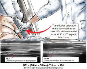 Medición de fracción de engrosamiento diafragmática.