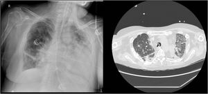 Radiological images. On the left are the conventional radiological findings and on the right are the computed tomography findings. Note the apparent disparity between lungs.