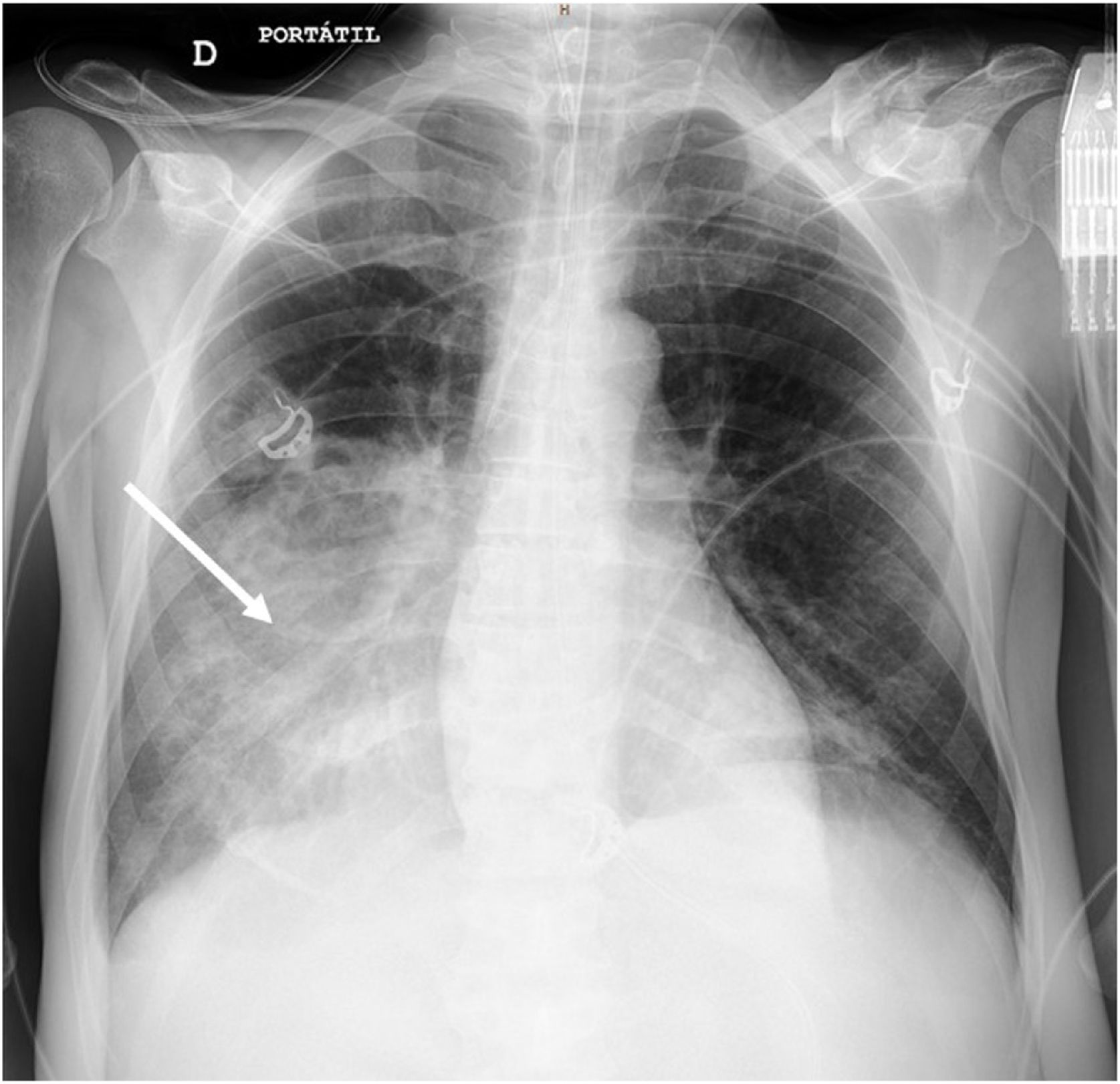 Dynamic air bronchogram in pneumococcal community acquired pneumonia ...