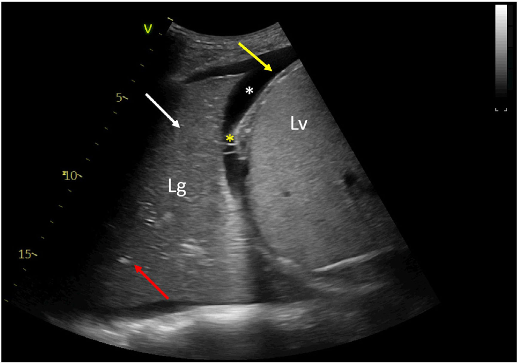 Dynamic Bronchograms Dynamic air bronchogram in pneumococcal community acquired pneumonia ...