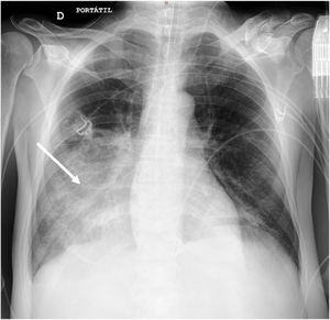 Anteroposterior chest X ray view showing a right lower lobe consolidation (white arrow).