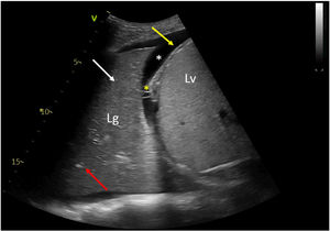 Lung ultrasound showing the diaphragm (yellow arrow), as well as lobar consolidation (white arrow), air bronchogram (red arrow), pleural effusion (white asterisk) and fibrin (yellow asterisk).