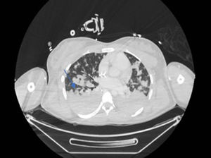 Émbolos sépticos coalescentes en todos los lóbulos pulmonares.