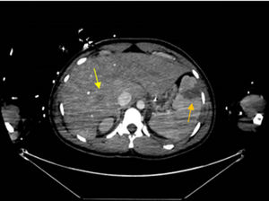 Pequeños abscesos en segmentos VIII y V-VI hepáticos. Área de infarto desde la periferia al hilio esplénico.