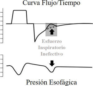 Representación gráfica de un esfuerzo inspiratorio inefectivo.