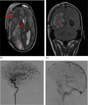 a) Difusión axial; b) en secuencia T2, coronales. Material electrónico suplementario: imágenes de arteriografía del paciente donde no se aprecian lesiones vasculares aneurismáticas ni malformaciones arteriovenosas (MAV).
