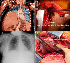 (A) A preoperative computed tomography (coronal slice) scan of the chest and upper abdomen confirmed a right hemidiaphragmatic hernia, showing a liver in the right chest. (B) Image during repair surgery. A wide diaphragmatic defect showed protrusion of the liver through it. (C) Postoperative chest radiograph after surgical repair. (D) The surgical suture appreciated the width of the diaphragmatic tear.