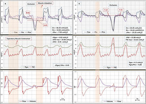 Traces of airway pressure (Paw), tracheal pressure (Ptra), oesophageal pressure (Pes), gastric pressure (Pgas), transdiaphragmatic pressure (Pdi), flow, and volume. Panel A, before surgery. During the expiratory occlusion manoeuvre, Paw and Ptra signals showed inability to maintain the PEEP set, as indicated by the descending step image, as the thorax and abdomen fused into a single compartment due to the diaphragmatic defect. Biphasic Pgas due to unilateral diaphragmatic injury and reduced Pdi. Note that Pes reflects the cyclic changes of Pgas—including expiratory muscle activation—and shares the same basal pressurization. Panel B, after the plication of the injured right diaphragm. The normalization of the signal during occlusion can be seen, as can the relationship between Pgas and Pes during inspiratory effort. Ers, Elastance respiratory system. Rrs, Total resistances respiratory system.