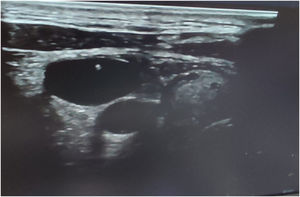 Out-of-plane technique showing needle appearing as an echogenic dot.