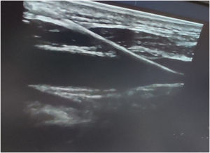In-plane technique showing guidewire appearing as an echogenic thread.