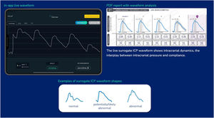 Noninvasive analysis of intracranial pressure waveforms.