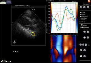 Speckle Tracking VVI analysis. Exploration of the thoracic descendent aorta using Speckle Tracking in the parasternal projection.