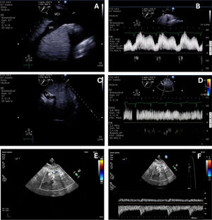 Protocolo VExUS por ETE. VCI: vena cava inferior; VH: vena suprahepática; VP: vena porta.