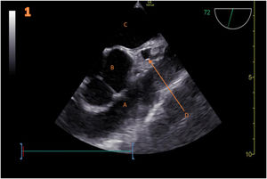 Mid-esophageal aortic valve short axis view.