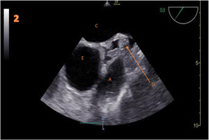 Image obtained after a slight retraction of the probe. A: right ventricular outflow tract. B: aortic valve. C: left atrium. D: transverse pericardial sinus fluid-filled with pericardial fat inside. E: ascending aorta.
