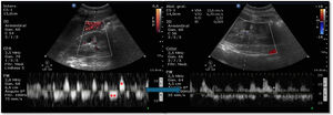 Picos sistólicos (*) y flujo venoso monofásico (**) en arterias interlobares renales, que se normalizan (IR de 0,57 y flujo fásico venoso) tras eculizumab.