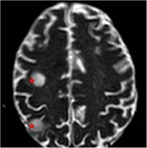 Dos lesiones hemisféricas cerebrales derechas ocupantes de espacio.