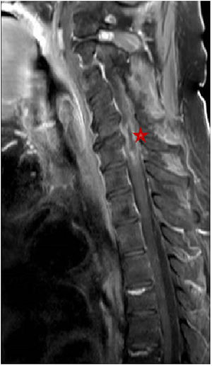 Colección fusiforme con realce periférico compatible de absceso intramedular que se extiende a nivel de la altura de C5 y C6.