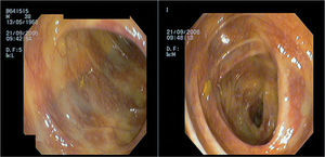 Imágenes de colonoscopia con afectación vascular de la submucosa.