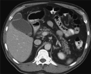 Tomografía computarizada que muestra una esteatosis hepática, sin evidencia de lesión parenquimatosa traumática y vesícula biliar de aspecto normal.
