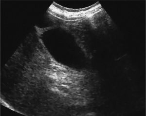 Ecotomografía abdominal, realizada 7 días tras el alta, que muestra una vesícula biliar sin contenido patológico.