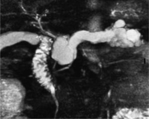 Imagen realizada mediante colangiopancreatografía por resonancia magnética, que muestra la imagen de un tumor papilar, mucinoso e intradutal, con anormalidades pancreáticas periductales y determina su relación con el conducto pancreático principal.