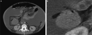 Apéndice epiploico normal en un abdomen con hemoperitoneo.