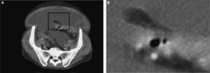 Apéndice epiploico normal en un abdomen con hemoperitoneo.