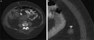 Apéndice epiploico calcificado, adherido a la pared del colon.