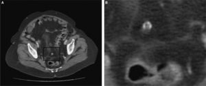 Apéndice epiploico calcificado.