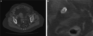 Apéndice epiploico calcificado.