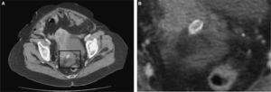 Apéndice epiploico calcificado.