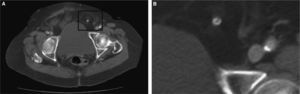 Apéndice epiploico calcificado.