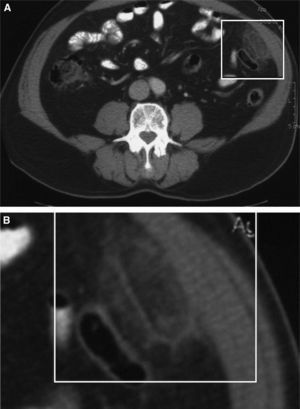 Apéndice epiploico inflamado: área hiperdensa en anillo con área central también hiperdensa.