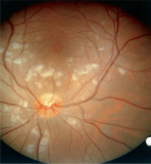 Exudados algodonosos en el polo posterior de la retina de ambos ojos.