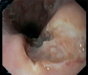 Imagen endoscópica de ulceraciones profundas en tercio medio esofágico.