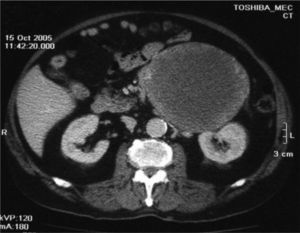 Imagen de la lesión en tomografía computarizada abdominal a mayor aumento.